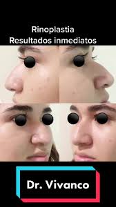 Dr. Marco Alejandro Vivanco Perez Otoerinolaringologia y Crugia Facial  #hospitalair #otorrino #belleza #perfil #rino #villahermosa #tabasco  #drvivanco #rinoplastiaultrasonica