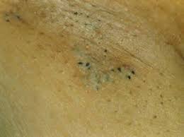 hidradenitis suppurativa da gozlenen klinik sikayetler
