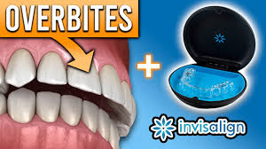However, if it is very severe, often braces is the best non surgical method of. Can Invisalign Fix Overbites Other Bite Problems Premier Orthodontics Youtube
