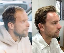 Finast 5 mg tablets for hair loss; Hair Loss Results Mosh