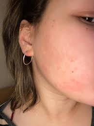 Kızarıklık Ve Kaşıntı