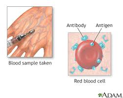 Serum Herpes Simplex Antibodies Information Mount Sinai New York