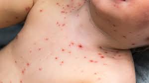 Who should get this vaccine? Chickenpox Overview Causes And Symptoms