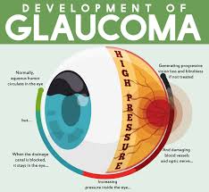 Image result for Glaucoma