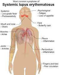 Treatment of rerfractory interstitial cystitis with intravesical hyaluronic acid. Taming The Wolf A New Treatment For Lupus Speaking Of Research