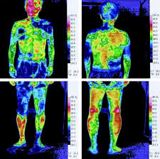 Image result for Anhidrosis