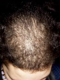 Men typically present with bitemporal thinning, thinning of the frontal and vertex scalp, or complete hair loss with. Male Pattern Alopecia Androgenetic Alopecia And Female Pattern Alopecia
