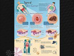 Over time, uv damage adds up, leading to changes in skin texture, premature skin aging, and sometimes skin cancer. Types Of Skin Cancer Ami 2018 Meeting