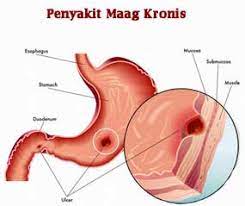 Definisi singkat mengenai penyakit maag kronis ; 6 Gejala Maag Kronis Diagnosa Pengobatan Pencegahan Halosehat