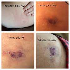 The woman who suffered this bite on her thigh suffered a necrotic ulcer that took weeks to heal. Progression Over The First 72 Of My Brown Recluse Bite I First Noticed It Around 7 45 Am On Thursday Brownreclusebites