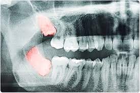 Why Don T All Wisdom Teeth Descend In Adults