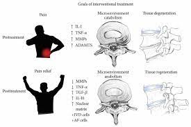 Back Pain And Disc Degeneration Anova Irm Germany