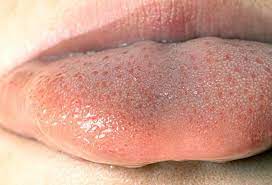When a person has lie bumps, small red or white bumps appear on their tongue. How Do You Get Rid Of Transient Lingual Papillitis