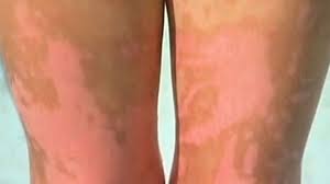 This picture illustrates a case of sunburn of 1st degree caliber. Limes Blamed For Girls Second Degree Burns Abc News