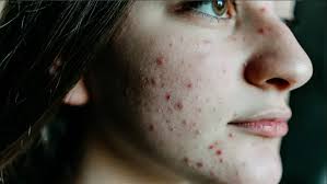 Experts Link Eczema to Sleep & Mental Health