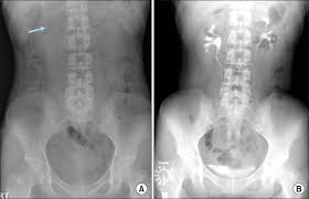 Image result for Intravenous Pyelogram