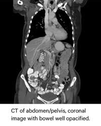 Finding colon cancer at its earliest stage provides the greatest chance for a cure. Diagnosing Abdominal Disease Two Exams One Goal Beekspeak The Blog Of Beekley Medical