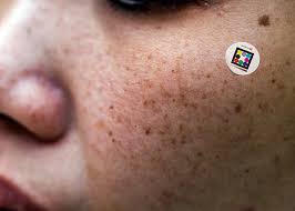 Image result for Solar Lentigo