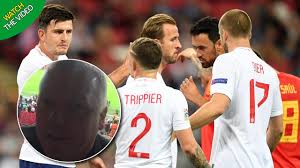 This has followed some serious injury problems in the past, including breaking his leg in two places during a champions league game against psv eindhoven in 2015. How Long Will Luke Shaw Be Out For Manchester United Star S Head Injury Latest After Picking Up Concussion Mirror Online