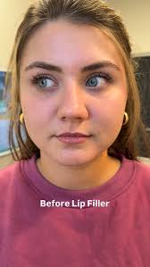 This gorgeous patient wanted just a little more volume in her lips, so she  came in with her sister and they both received lip filler for the first  time — with Dr. Pflederer. 💋 It’s amazing what a ...