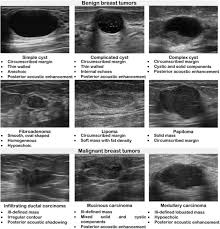 Not all suspicious breast lesions will direct in appearance and ultrasound diagnosis. Deep Feature Extraction And Classification Of Breast Ultrasound Images Springerlink