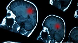 To cite the most obvious difference, john's xy brain now finds itself in an xx body. 7 Symptoms Of Common Brain Tumors You Should Know Atlanta Business Chronicle