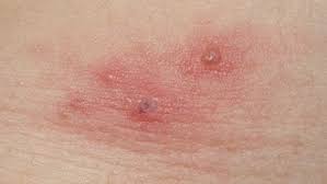 Опоясывающий герпес (herpes zoster, shingles), опоясывающий лишай. æ¯Žæ—¥ãŒå¸¯çŠ¶ç–±ç–¹ ãƒãƒ§ãƒ­ã„ç–¾æ‚£ã¨ä¾®ã‚‹ãªã‹ã‚Œ 3ãƒšãƒ¼ã‚¸ç›® æ—¥çµŒãƒ¡ãƒ‡ã‚£ã‚«ãƒ«