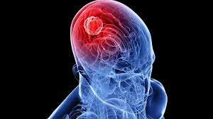La esclerosis lateral amiotrófica (ela) es una enfermedad neurodegenerativa en la que hay una destrucción progresiva de las neuronas, lo que acaba provocando parálisis ministerio de sanidad y política social. Gdmx4riijhyhjm