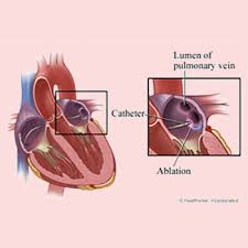 Image result for Radiofrequency Surgery