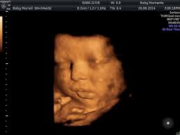 Pin On Edwards Syndrome