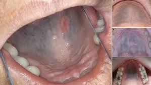 Image result for Mouth ulcers symptoms roof of the mouth