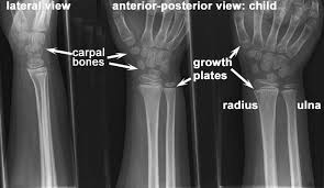Normal Wrist Joint Child Radius And Ulna X Ray Becoming A Doctor