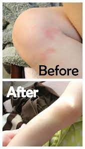 The Best Remedies For Toddler Rashes Homemade For Elle Eczema Remedies Natural Eczema Treatment Itchy Skin Relief