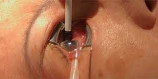 Check spelling or type a new query. Pneumatic Retinopexy For Rhematogenous Retinal Detachment American Academy Of Ophthalmology