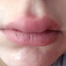 In vielen fällen wird die schwellung der oberlippe von offenen oder blutenden stellen begleitet. Dicke Lippe Pickel Hilfe Angeschwollen