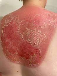 Dermatomyositis | Causes | Best treatment Option | Homeopathic | Best Homeopathic Doctor in Pakistan | Dr Qaisar Ahmed MD, DHMS