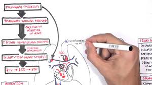 Pulmonary Embolism Part I Overview