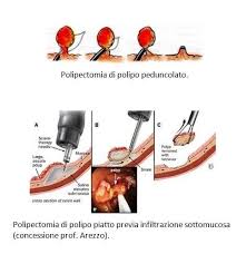 Verdura , frutta, cereali integrali e crusca d'avena. Terapia Endoscopica Dei Polipi Intestinali Roma Gastroenterologo Dott Prof Antonio Iannetti