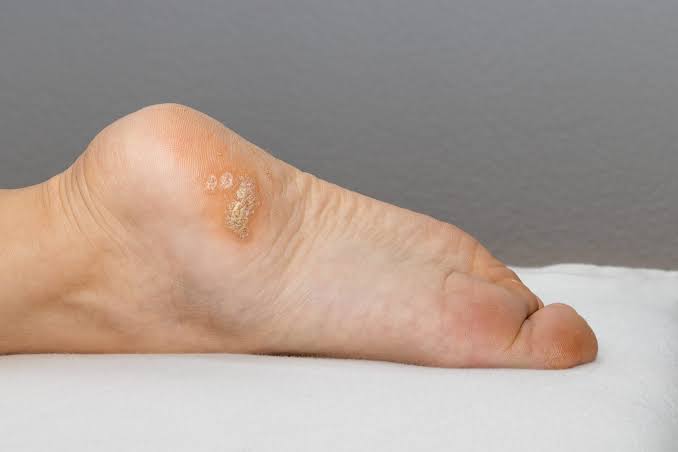 Plantar Warts Treatment in Flushing Queens & New York, NY