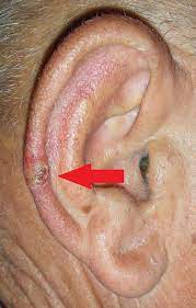 According to the american cancer society, just over 100,000 new cases of skin cancer are diagnosed in the united states each year. Skin Cancer Ear Dr Damian Marucci Cosmetic Plastic Reconstructive Surgeon