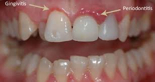 Treat Periodontal Disease Archives Dentist In Duncanville Tx Singla Dental