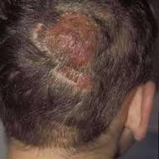 Image result for Tinea Capitis