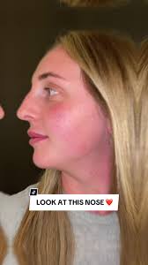 👉🏻 **EXPERIENCE HIGH DEFINITION RHINOPLASTY WITH DR. NEO!** 👈🏻  ———————————————————————— ✔️ **Rhinoplasty Made Simpler Than Ever!** ✔️  **Revolutionary High Definition Rhinoplasty with Piezoelectric ...