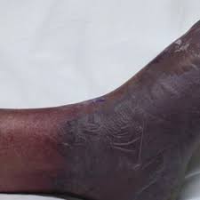 Maybe you would like to learn more about one of these? Asalnya Cuma Terseliuh Tetapi Kaki Bengkak Bertukar Warna Hitam