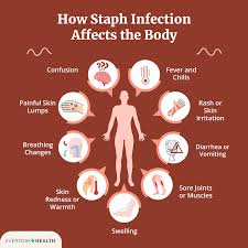Symptoms of Staph Infection