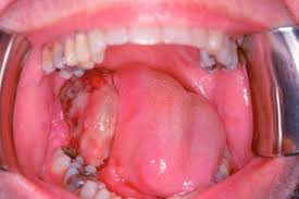 Image result for spinocellular carcinoma of the oral cavity