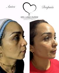 PRETTY FACE 😍 Un protocolo completamente personalizado para cada paciente.  Citas vía WhatsApp 321-812-9594