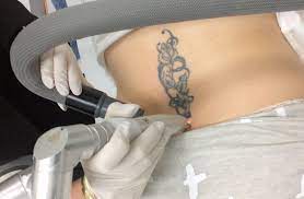 The best way to describe it is a small rubber band snapping against your skin. Does Laser Tattoo Removal Hurt More Than A Tattoo Image By Laser