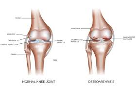 Image result for Knee Joint Injection