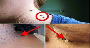 Many women with fibroids have no symptoms. Yuk Atasi Tumor Fibroid Kulit Berlebih Di Tubuh Begini Cara Mudah Untuk Menghilangkannya News Update